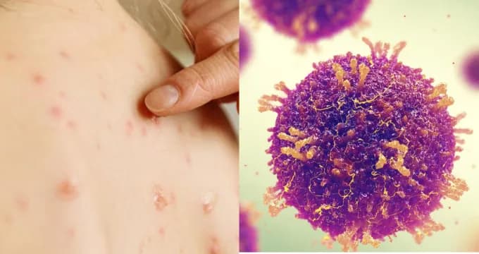 Sarampión cede terreno: México acelera vacunación y baja transmisión