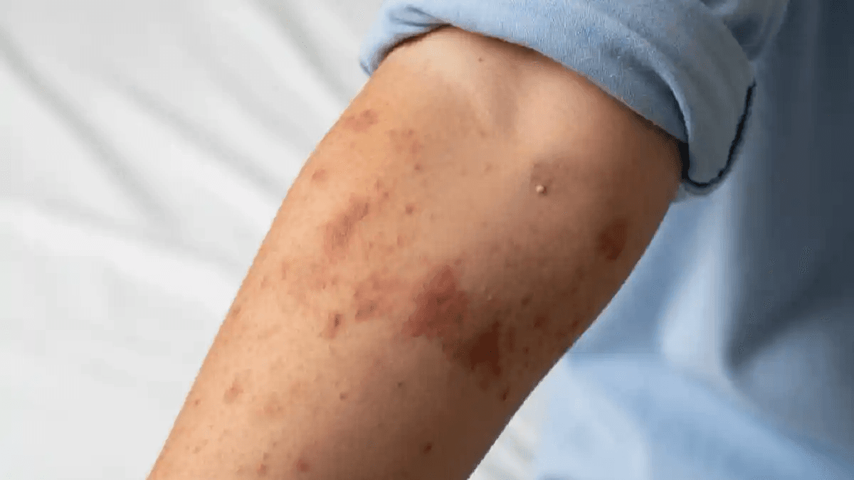 Secretaría de Salud confirma primer caso de sarampión en Puebla