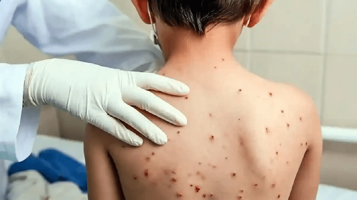 Van en Puebla 53 casos confirmados de sarampión